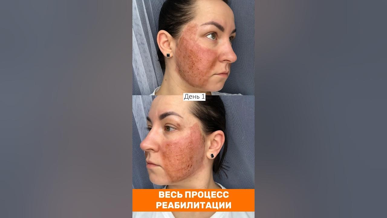 Как избавиться от ШРАМОВ после АКНЕ? Результат до и после. Лазерная ...