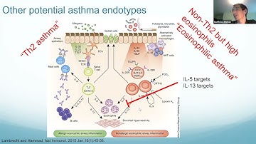 Biomarkers and Biologics in Asthma