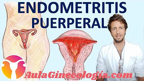 ¿Cuáles son los factores de riesgo de la endometritis?