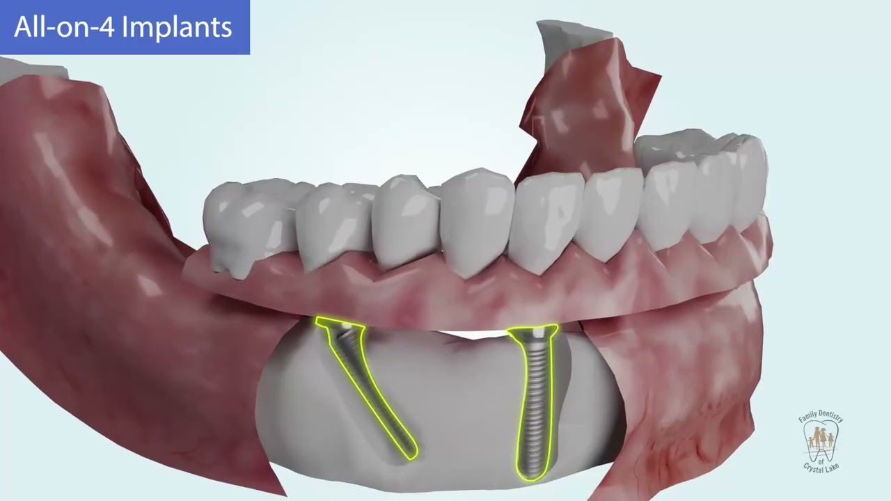 All-on-X Dental Implants: Full-Arch Teeth Replacement Explained