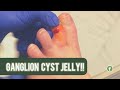 GANGLION CYST JELLY