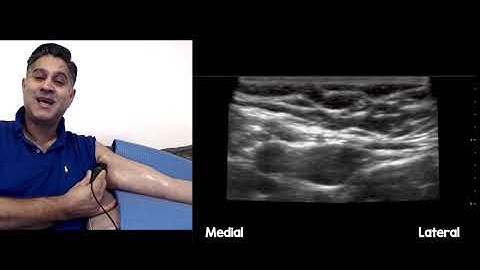 Medial Antebrachial Cutaneous Nerve block (medial cutaneous nerve of the forearm)
