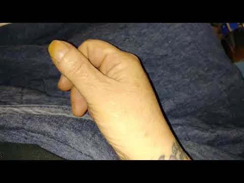 My Trigger Thumb Journey Part 1