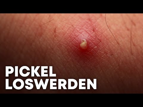 Video: So wirst du einen Pickel im Gesicht schnell los