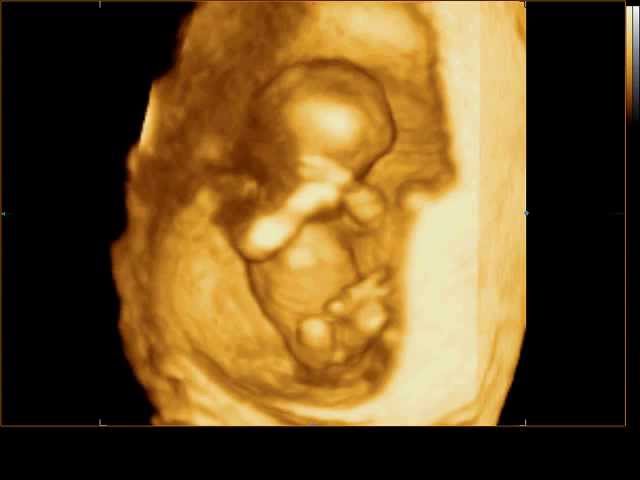 Плод 11 недель фото. 3д УЗИ 11 недель беременности. Плод на 12 неделе беременности фото плода на УЗИ. 3д УЗИ на 13 неделе беременности. Плод в 12 недель беременности мальчик.