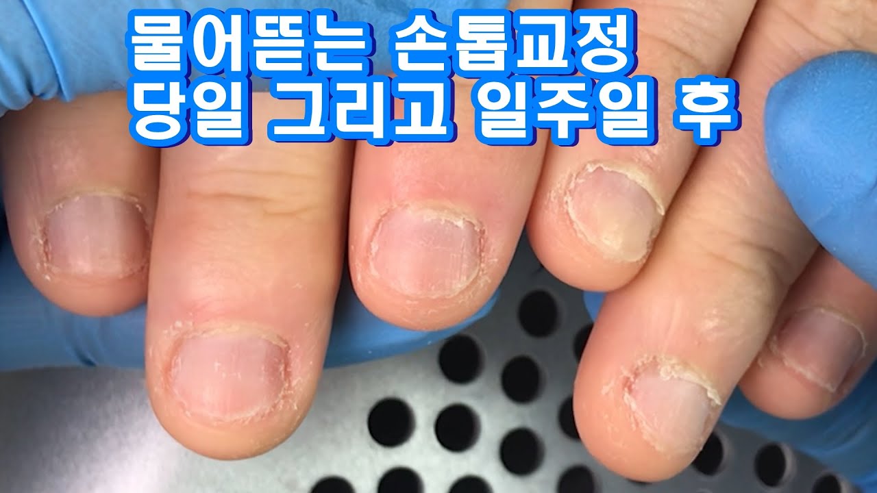 bite nails acrylic 손톱이 짧은데 손톱연장 가능한가요? 거스러미?큐티클? 너무 많은데 가능한가요? 물어뜯는 손톱