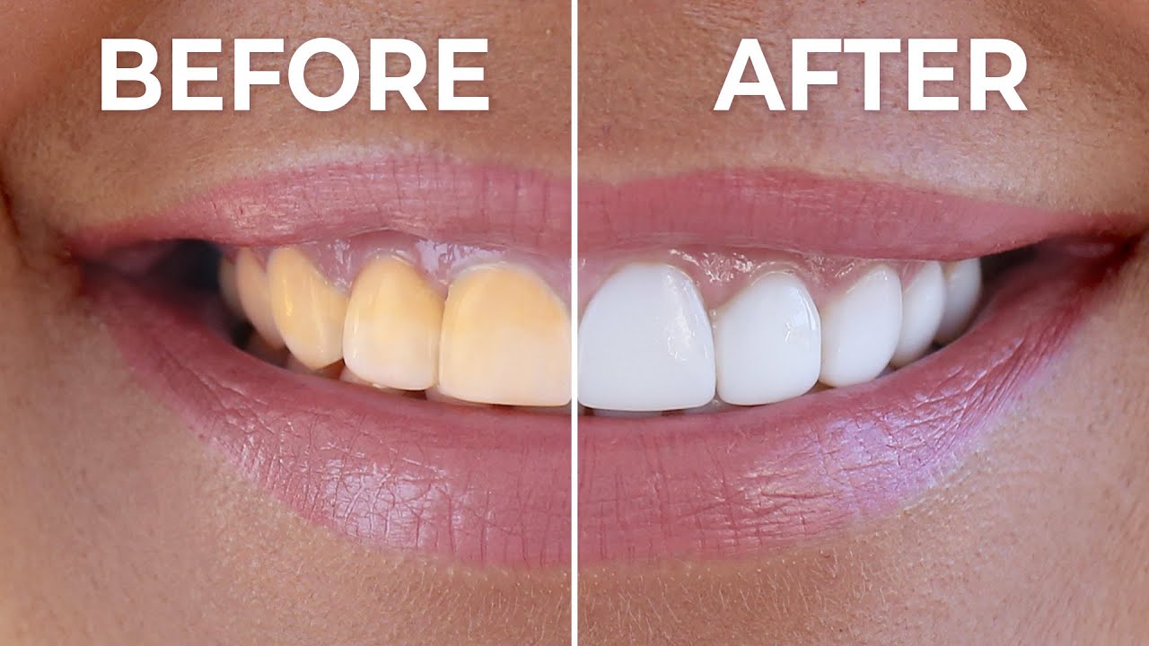 Instant Teeth Whitening At Home How To Naturally Whiten Yellow Teeth Instant Teeth Whitening At Home How To Naturally Whiten Yellow Teeth