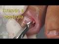 😣 Uma das unhas mais difíceis da semana, cheia de dor e inflamação! #satisfying #nails