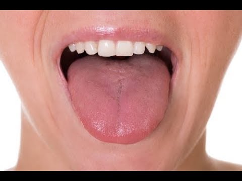 Video: 3 manieren om een tongzweer te genezen
