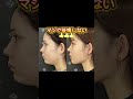 アゴ下脂肪吸引注射は後悔しない!