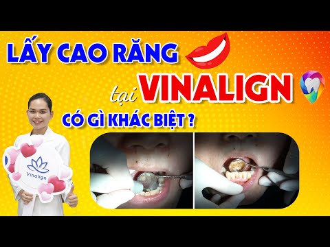 Lấy Cao Răng Tại Vinalign Có Gì Khác Biệt