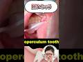 腫れ上がっている部分をレーザーで治療!先生が解説!#shorts