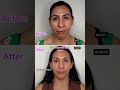 before and after #BrowLift#BeforeAndAfterBeauty #FreshFaceGlow #BotoxResults #InjectablesJourney