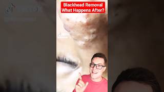 What Happens To The Hole - BLACKHEAD REMOVAL Update shorts