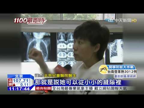 20150831中天新聞　女童誤吞9公分金屬鏈　卡氣管險死