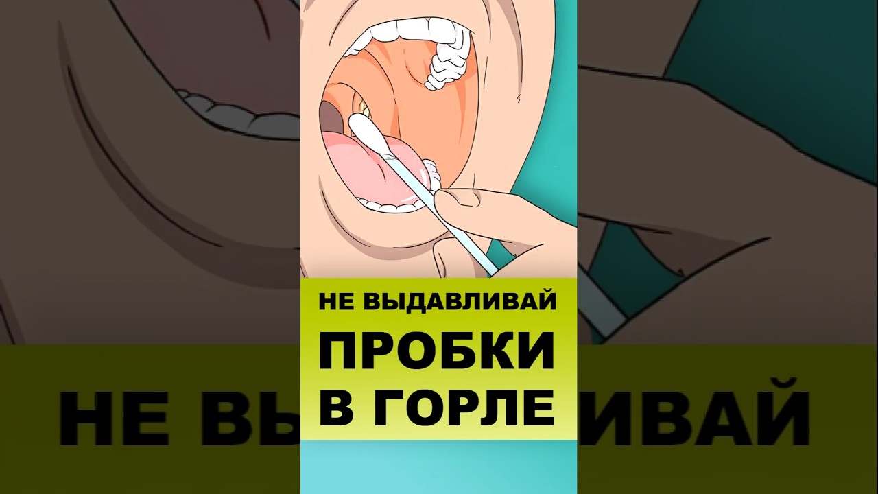 ПОЧЕМУ ОПАСНО ВЫДАВЛИВАТЬ ПРОБКИ #пробкивгорле #тонзиллит #гнойныепробки