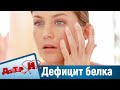 Дефицит белка, камни в почках. "Доктор И"