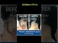 Homeopathy treatment of Eczema (एक्जिमा)