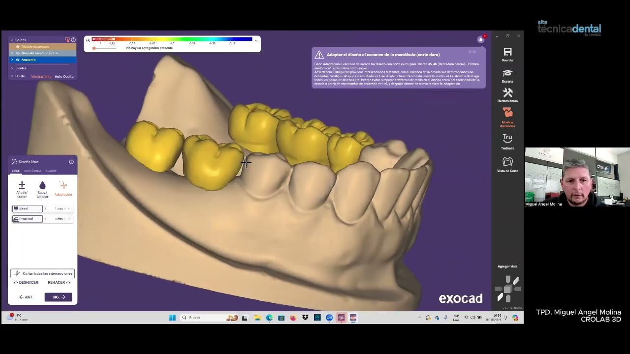La nueva era de la prótesis Dental Flexible con TPD. Miguel Angel Molina (ARGENTINA)