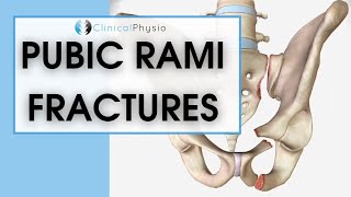 Pubic Rami Fractures | What are they? How do you treat them? screenshot 5