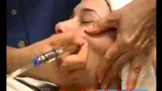 microdermabrasion -تقشير البشره بواسطة جهاز الكريستال