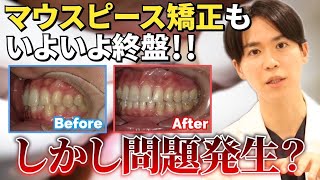 マウスピース矯正】マウスピース矯正もいよいよ終盤！しかし問題