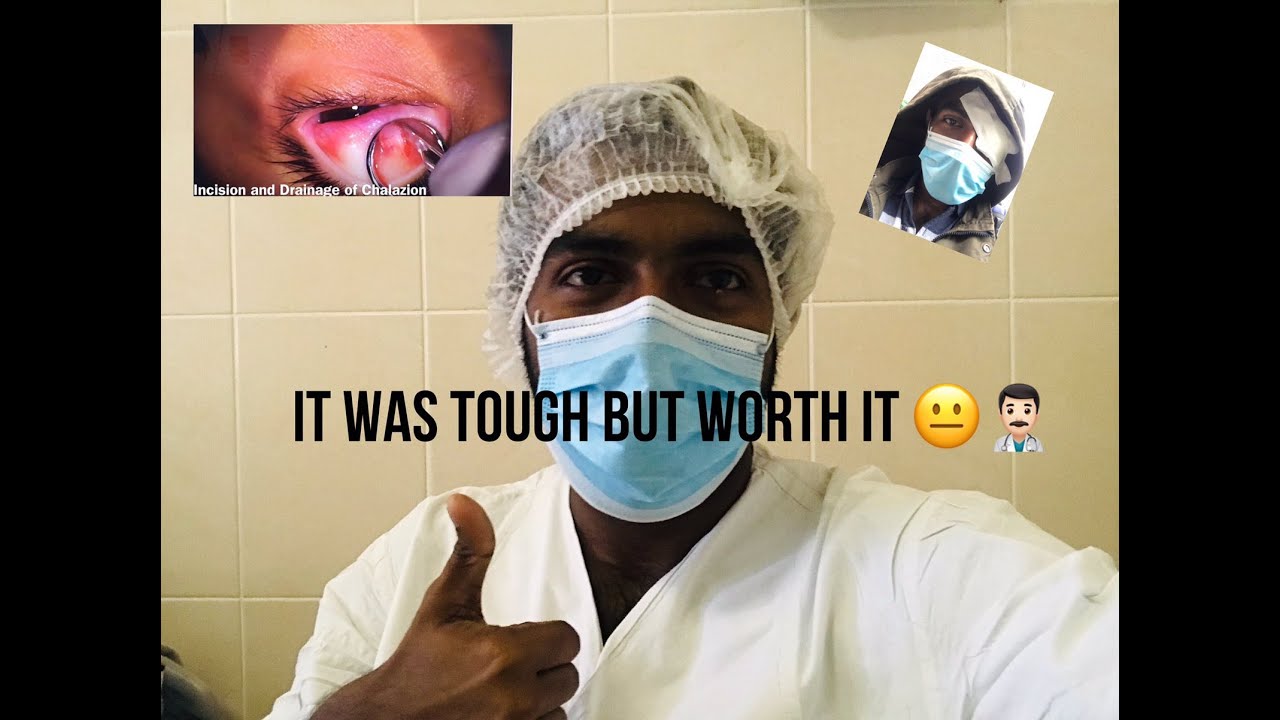Chalazion removal Surgery My Journey with Chalazia for 6 months