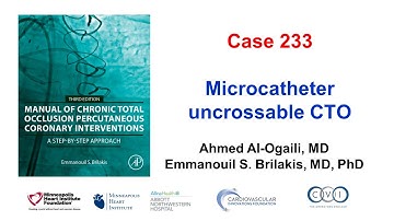Case 233: Microcatheter uncrossable CTO
