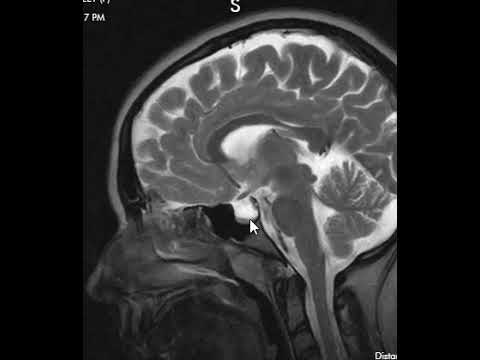 تصویری: نحوه درمان شبه تومور مغزی: 13 مرحله (همراه با تصاویر)