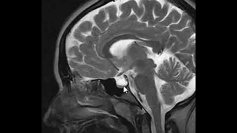 Pseudotumor Cerebri - Brain Scan MRI