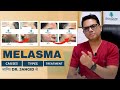 All about melasma  causes types and treatment options   dr jangid     skinqure