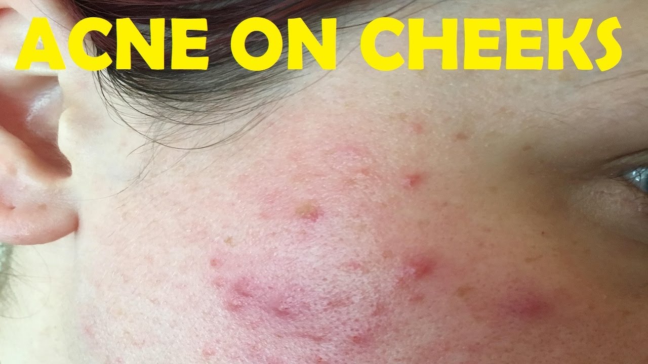 How To Get Rid Of Acne On Cheeks EASY SOLUTION YouTube how-to-get-rid-of-acne-on-cheeks-easy-solution-youtube