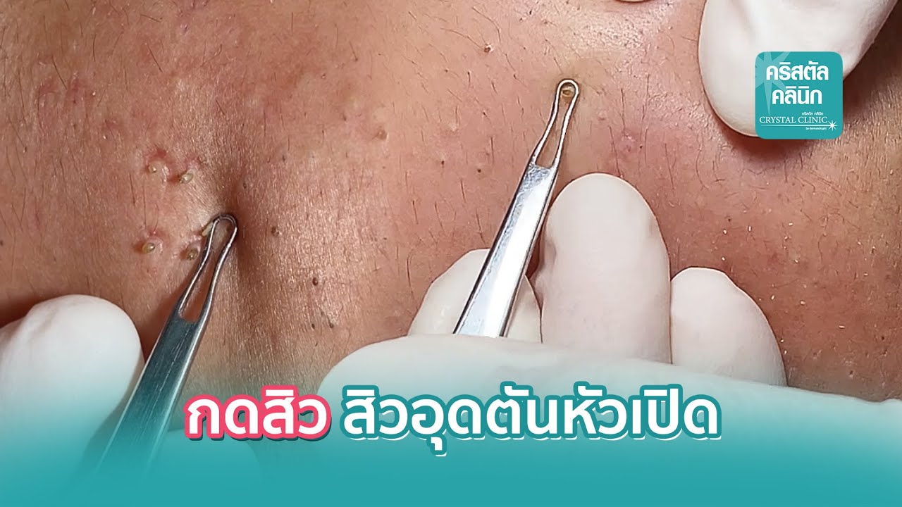 กดสิว กดสิวอุดตัน กดสิวอุดตันหัวเปิด | โดยคริสตัลคลินิก มหาสารคาม