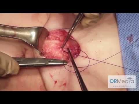 Excision of Urachal Cyst