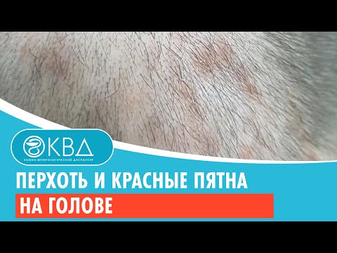 😟 Перхоть и красные пятна на голове. Клинический случай №799