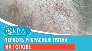 😟 Перхоть и красные пятна на голове. Клинический случай №799