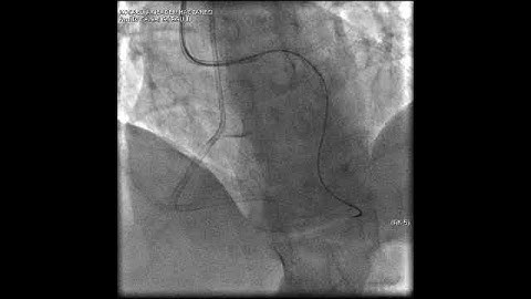 Aortic dissection and radial rupture during retrograde CTO PCI: Management of complications VİDEO 26