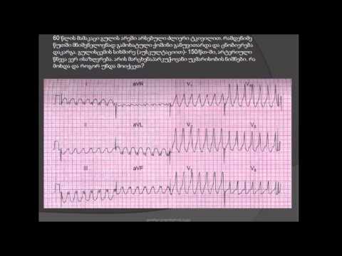 პარკუჭოვანი ტაქიკარდია (ვენტრიკულური ტაქიკარდია) / parkuchovani taqikardia / კარდიოგრამის წაკითხვა