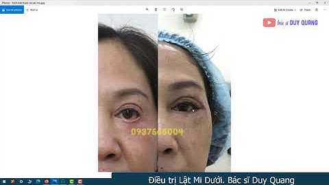 LẬT MI DƯỚI  |  Tuyệt chiêu cuối cùng BS DUY QUANG[#TạoHìnhThẩmMỹMắt]