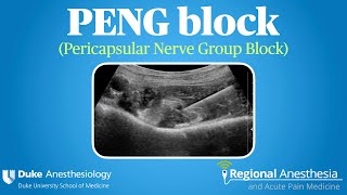 PENG Block (Pericapsular Nerve Group Block)