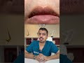 هذه ليس ميليا هذه تسمى   وتروح بالليزر دكتور علي العيد تجميل جلدية