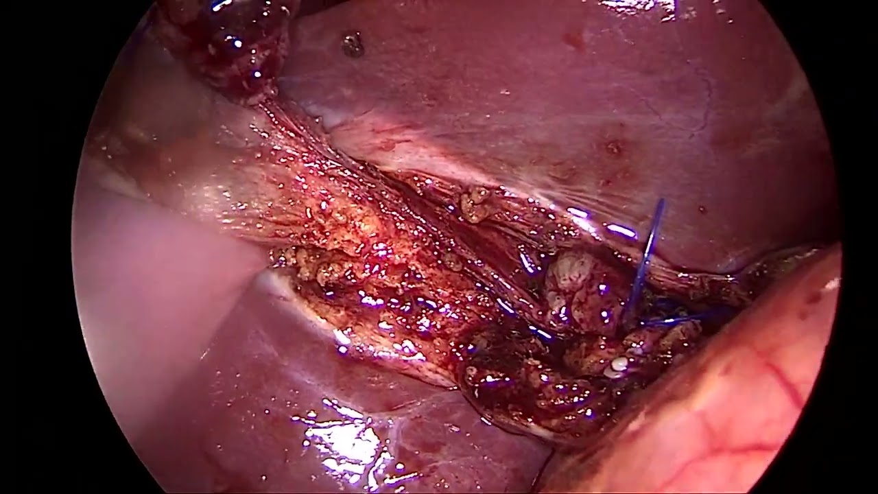 17012022 Laparoscopic cholecystectomy with intraoperative cholangiogram (LC+IOC) part 3