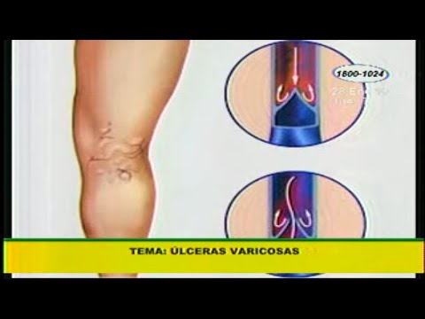 crema para ulceras varicosas argentina