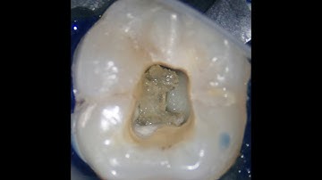 Pulp stone removal - Safe & predictable method.