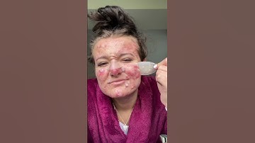 Best Pimple Patch Removals