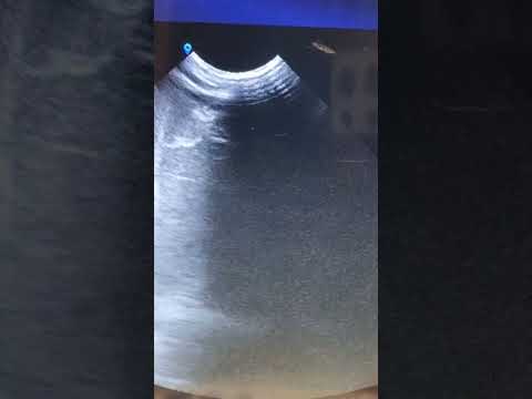 تومور کل شکم رو گرفته تو چهار سالگی و بدن تحت فشار توده آب آورده است