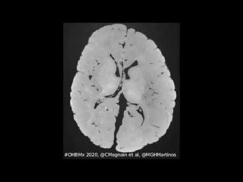 Video: Tracciamento Di Cellule MRI Ex Vivo Di Cellule Strench Mesenchimali Autologhe In Un Modello Di Difetto Osteocondrale Ovino