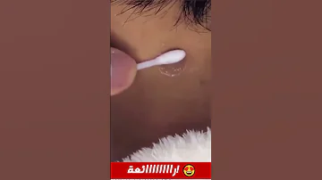 كريم لإزالة الشامة والثؤلول 