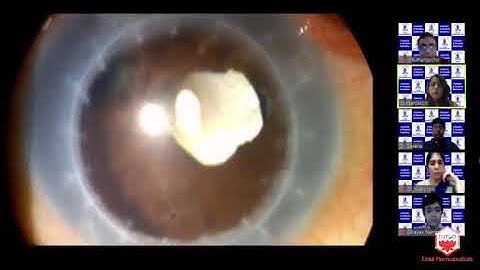 Video Bouquet-Cataract Surgery in Complex Cases. Interactive Video Based ..-Dr.Soosan Jacob(2)
