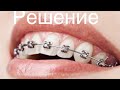 Решение о брекетах. Помощь неудачный опыт